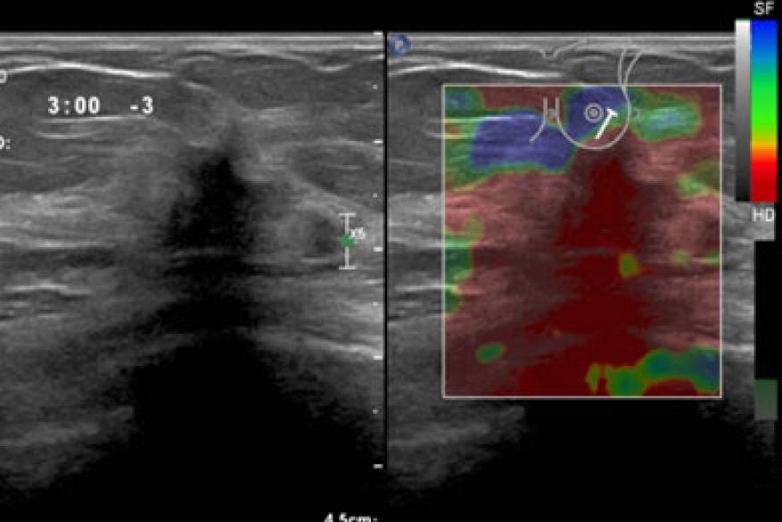Ελαστογραφία μαστών Ελαστογραφία μαστών