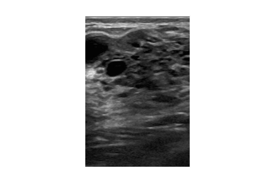 Ινοκυστικές αλλοιώσεις Ινοκυστικές αλλοιώσεις