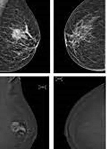 Ψηφιακή μαστογραφία με ενδοφλέβια χορήγηση σκιαγραφικής ουσίας (CEM)